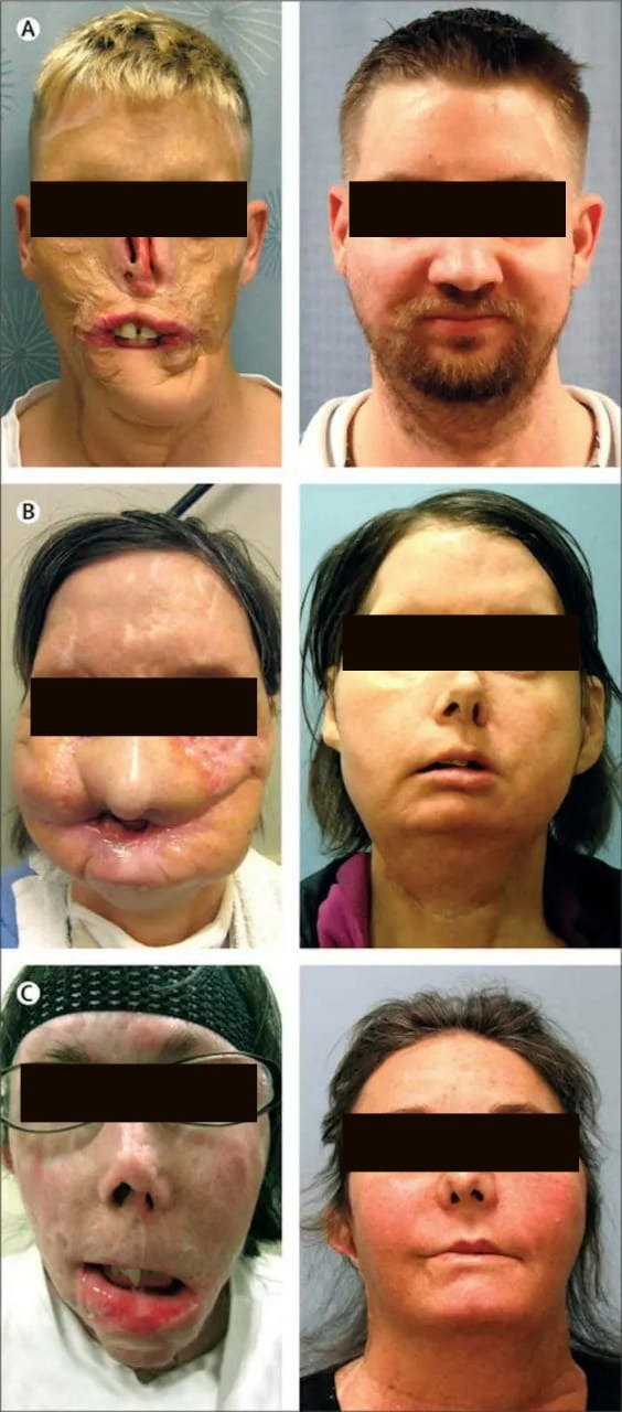 Facetransplant